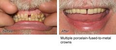 Crowns4