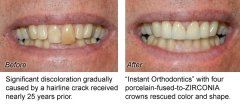Crowns5