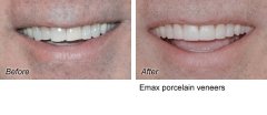Veneers1