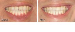 Veneers10