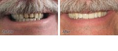 Veneers11