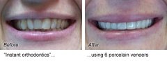 Veneers12