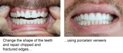 Veneers2