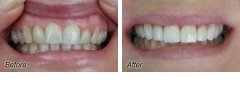 Veneers3