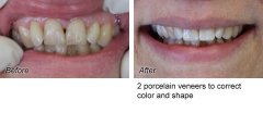 Veneers4