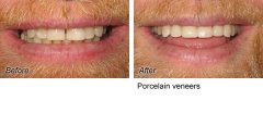 Veneers5
