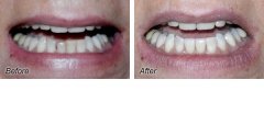 Veneers6