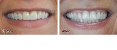 Veneers7