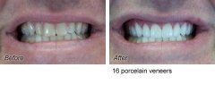 Veneers8