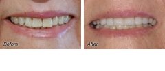 Veneers9